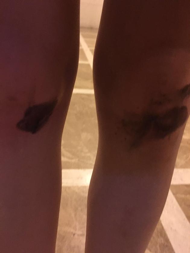 叶一云骑行玩漂移摔伤微博晒照粉丝心疼