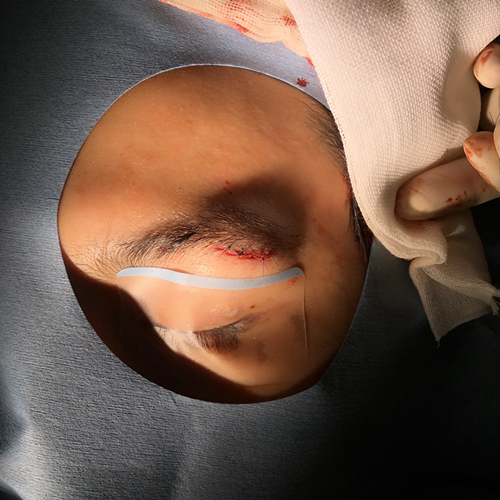 张哲瀚《极速》受伤