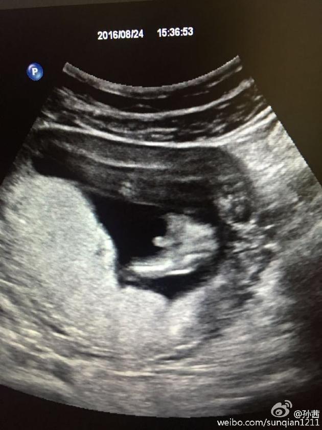 怀孕b超单 早孕图片
