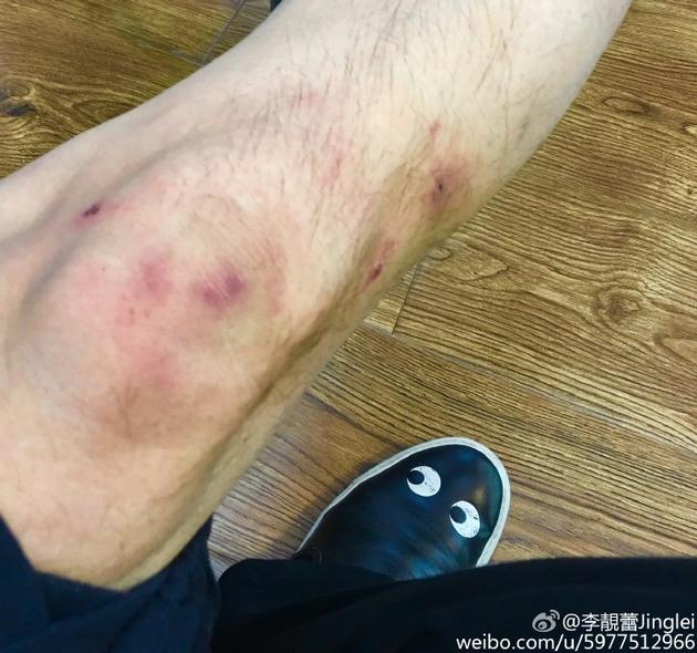 李靓蕾晒出王力宏膝盖受伤的图