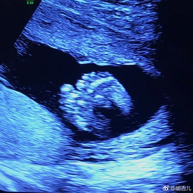 怀孕6周b超单图片图片