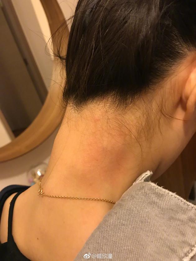 钟欣潼忙于演唱会旧伤加重后颈红肿惹粉丝心疼