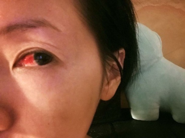 红眼
