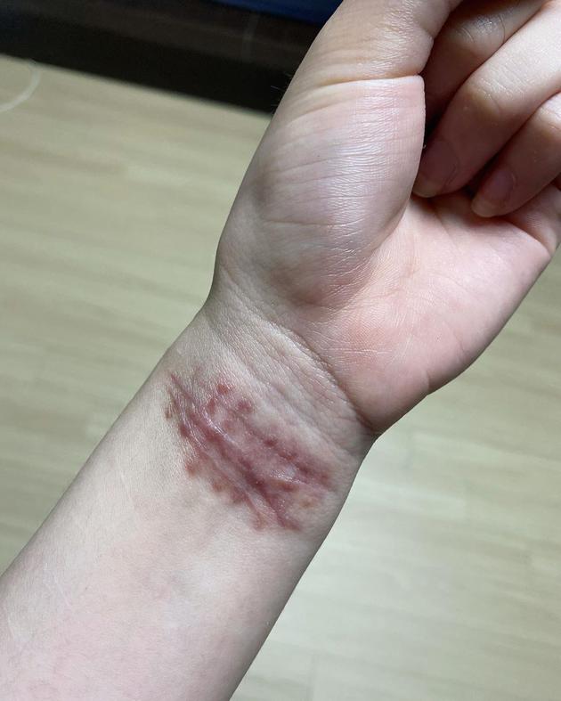 AOA权珉娥自曝被欺凌后发照 割手腕伤疤触目惊心