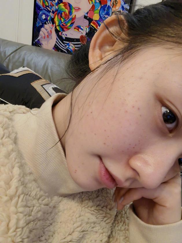 林允手打水光针晒自拍脸上针孔明显|林允|水光针|素颜_新浪娱乐_新浪