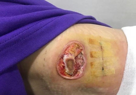 脂肪瘤手术疤痕图片