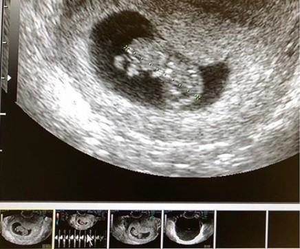 怀孕两个月b超图图片