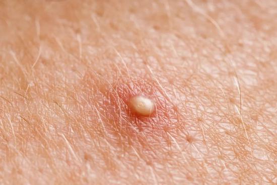 在干架的过程中,原先的白头和黑头会变成丘疹或脓疱,再严重点的话