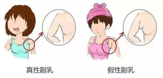 而假性副乳则是后天形成的赘肉,一般是由于穿衣不当或者是肥胖造成的.