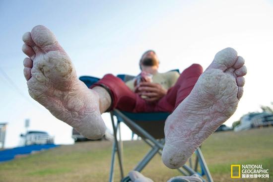 美国德州，一名男子在参加完独木舟比赛之后，双脚已经被水泡得发白发胀。摄影：BLAKE GORDON， AURORA
