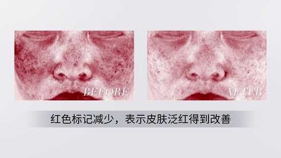 使用大银盾面霜calmSL组合物7天淡红效果