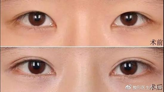 样看到前后的对比图,是不是很心动,但是因为埋线和切开法双眼皮不同