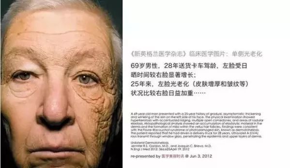 《新英格兰医学杂志》单侧光老化的临床医学图片