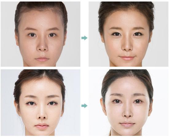 毛发移植让你拥有完美发际线