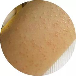 鸡皮肤去掉腿毛后发红(鸡皮肤去掉腿毛后发红发痒)