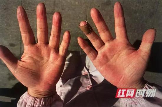  李蓝星被消毒液浸泡过度的双手。