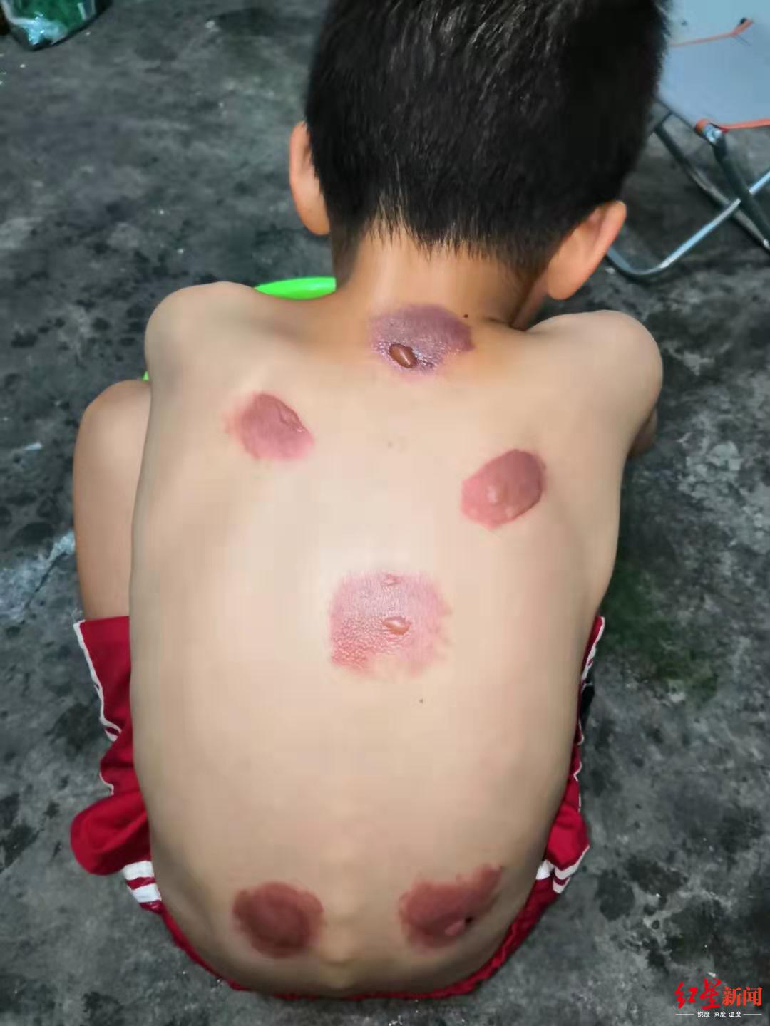 ↑被灼伤后,孩子痛苦地蹲在地上