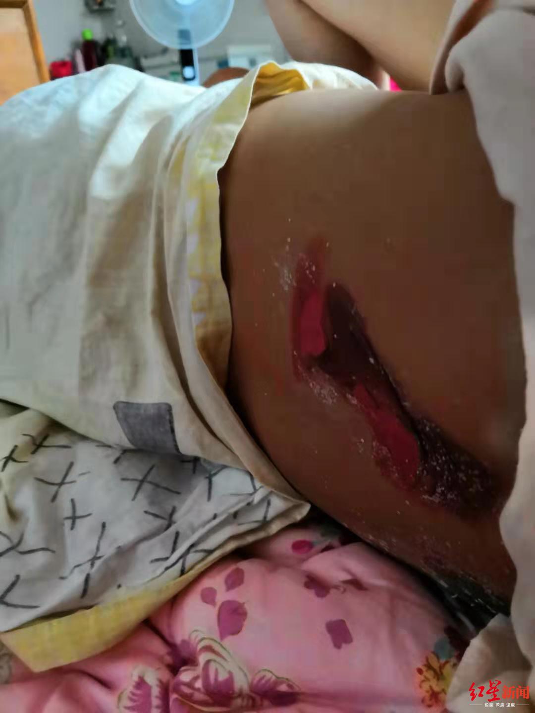 ↑一名儿童被灼伤后,卧床休息