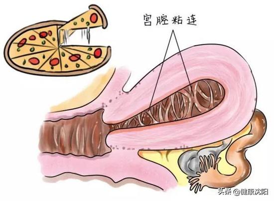 警惕备孕路上的杀手——宫腔粘连