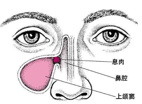 上颌窦是鼻窦中的一个,它是一个空腔,大体位置位于我们的颧骨后面