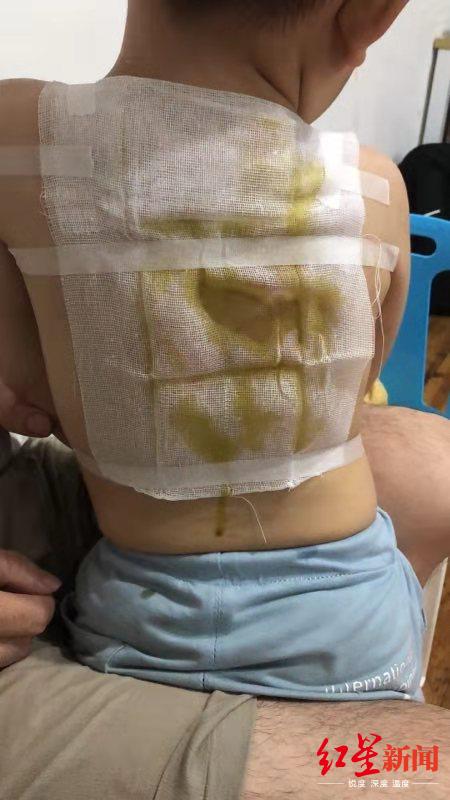 ↑被三伏贴灼伤后,孩子的背部大面积被包扎