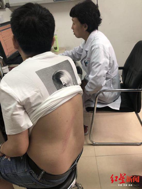 ↑ 陈先生被烫伤的背部
