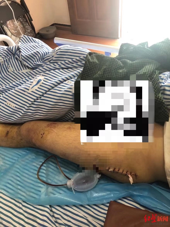 多功能病床控制怎么江西小伙因“百万年薪”被骗到缅甸从事电信诈骗，逃跑时遭殴打至手腿粉碎性骨折_https://www.jmylbn.com_新闻资讯_第4张