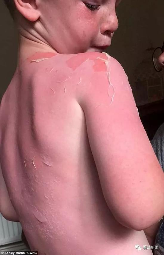五岁英国男孩使用香蕉船防晒霜后出现皮肤烧伤