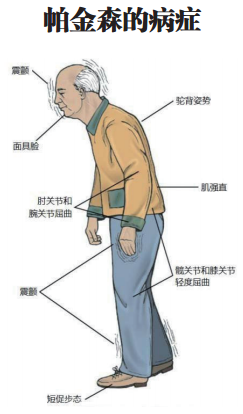 治疗帕金森病应“细水长流”
