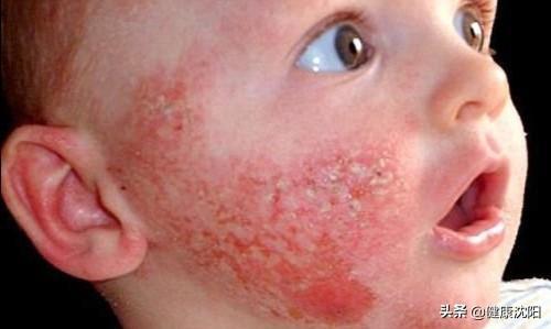 关注儿童过敏性皮肤病