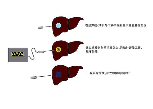 腹腔镜下肝癌射频消融术