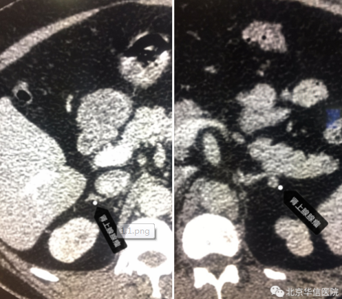 满月脸 水牛背 揪出高血压背后隐藏的“秘密”