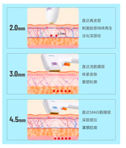 半岛超声炮在传统超声刀的基础上进行了优化升级,采用和过去不同的大