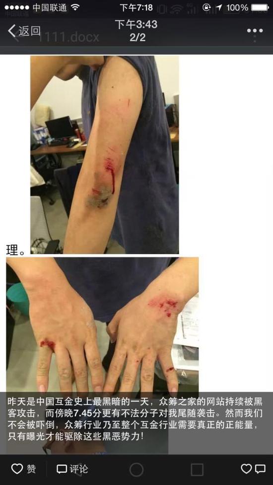 王正然在朋友圈发布的受伤照片.