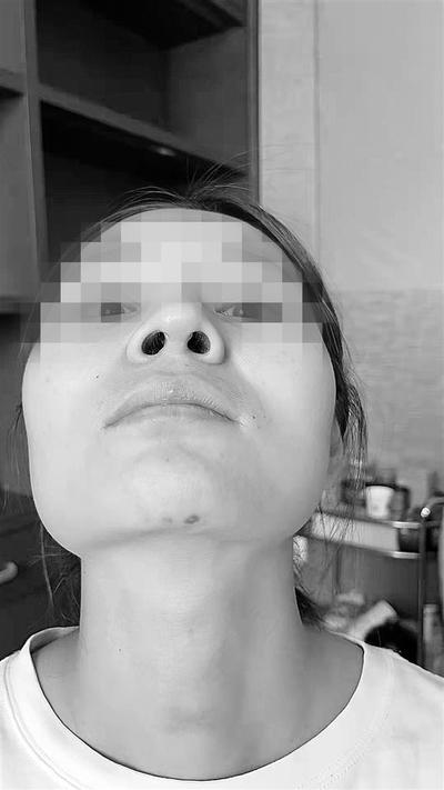 24岁女孩做隆鼻手术 没想到把鼻子整歪了