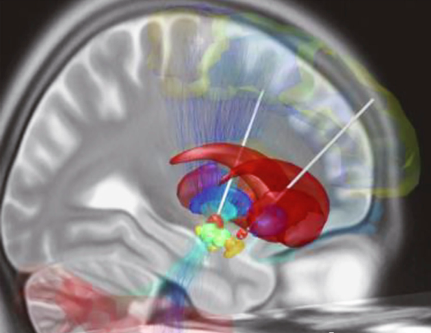 深部脑刺激设备电极通常用于治疗帕金森病 图源：中国工程院院刊