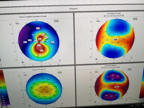 圆锥角膜早期病变表现为角膜表面异常隆起,角膜地形图可以体现角膜