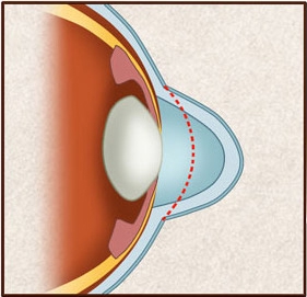 怎么识别圆锥角膜厦门眼科中心圆锥角膜工作室专家告诉你