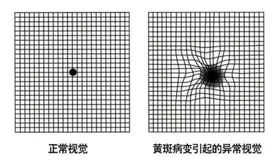 夏天紫外线强烈谨防黄斑病变50岁以上者定期行眼底检查