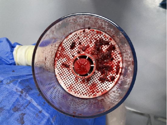 机械血栓抽吸系统抽取出的血栓