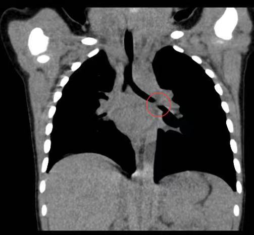 CT检查发现，幼儿左侧主支气管有一个6mm*4mm的异物。