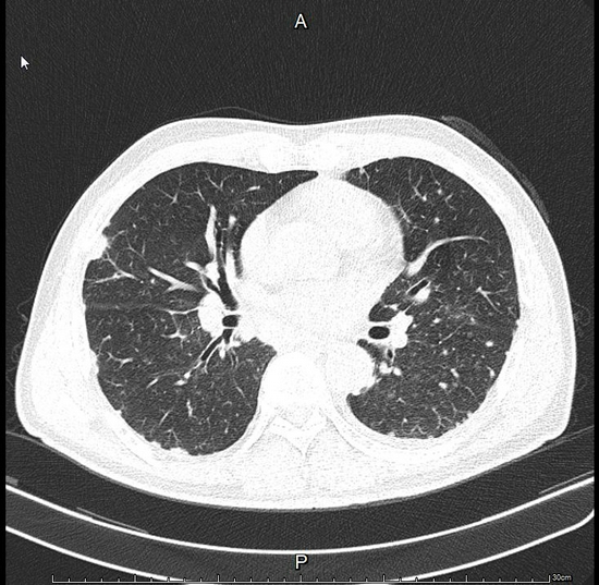 胸膜结节是好是坏神探胸腔镜明确诊断