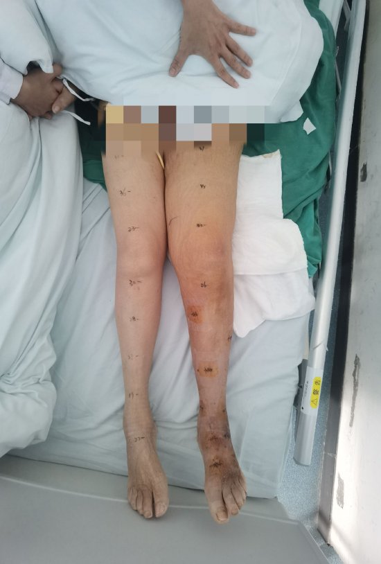 术后第二天，患者左腿肿胀情况明显缓解，皮肤也松解了