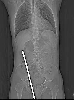 钢筋由患者的会阴部经过盆腔进入腹腔，插入体内约35cm，竟奇迹般地“避开”了脏器和大血管。