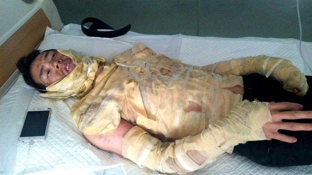 遵义男子全身30被香蕉水烧伤不能这么做