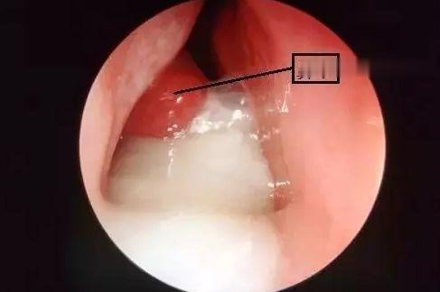 鼻涕|宝宝|鼻粘膜_新浪网