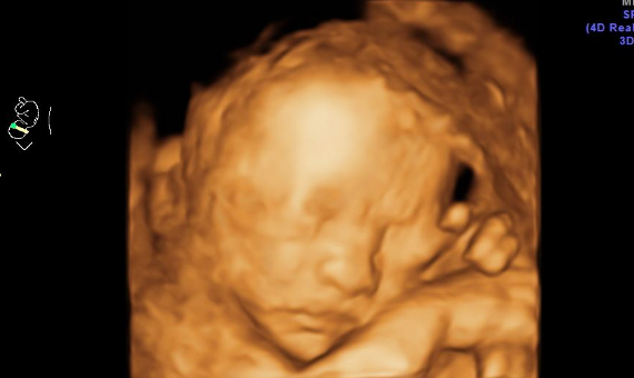 孕期做四维彩超,要明白5点重要性,不然白白浪费钱