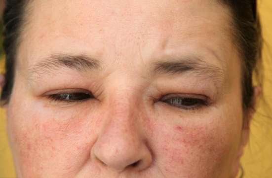 31岁销售员患肺癌,医生:若脸上出现1种"浮肿",许肺已受损