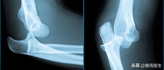 宝宝胳膊爱脱臼,为什么|胳膊|桡骨|韧带_新浪新闻