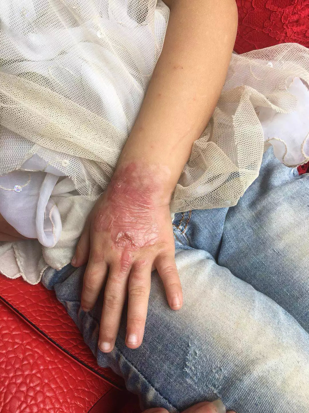 手机爆炸致5岁女孩八级伤残,索赔175万元 三星:电池非原产